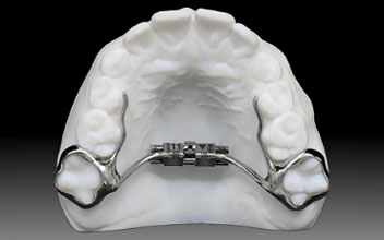 palatal expander