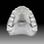 palatal expander